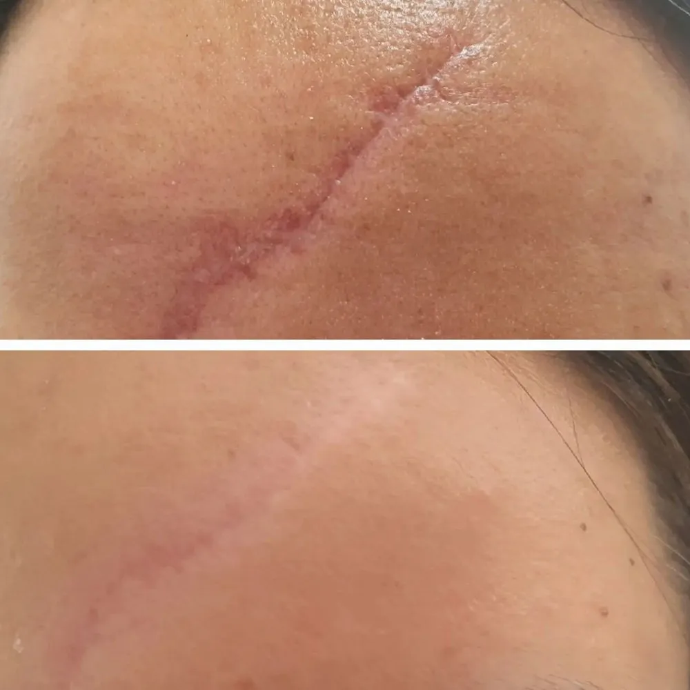 Resultado real de Tratamento de cicatriz facial, comparação antes e depois