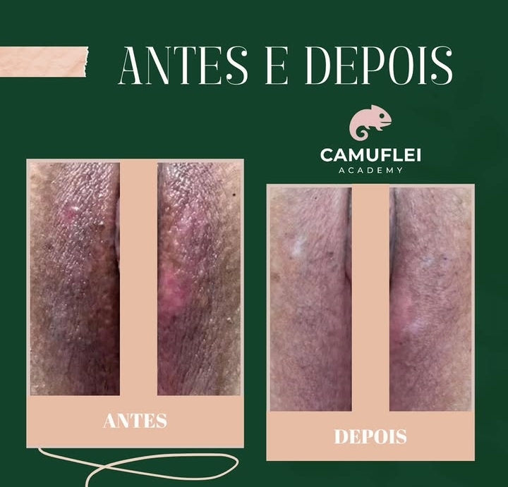 Resultado real de Camuflagem de estrias, comparação antes e depois