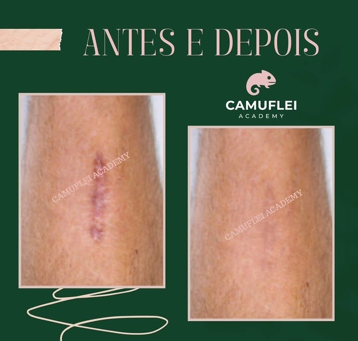 Resultado real de Camuflagem de cicatriz, comparação antes e depois