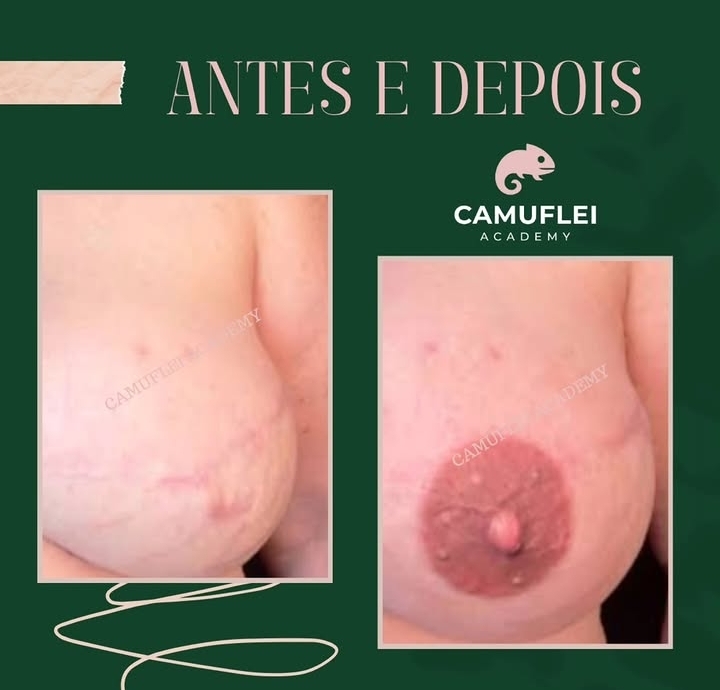 Resultado real de Harmonização de aréola realista 3D, comparação antes e depois