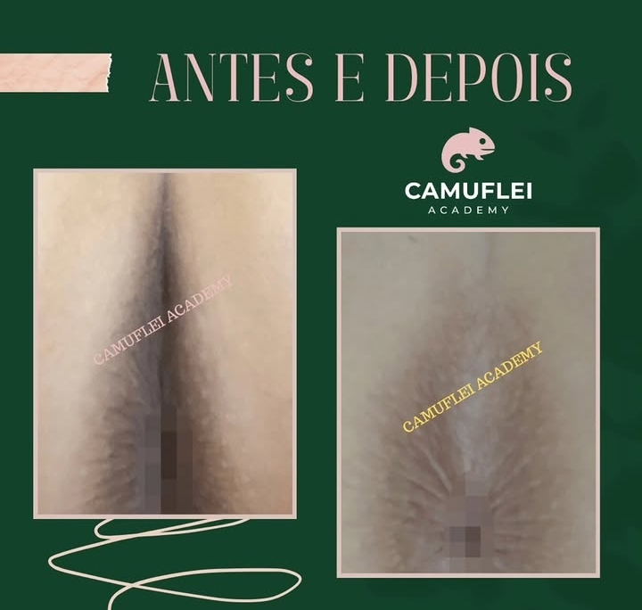 Resultado real de Camuflagem íntima, comparação antes e depois