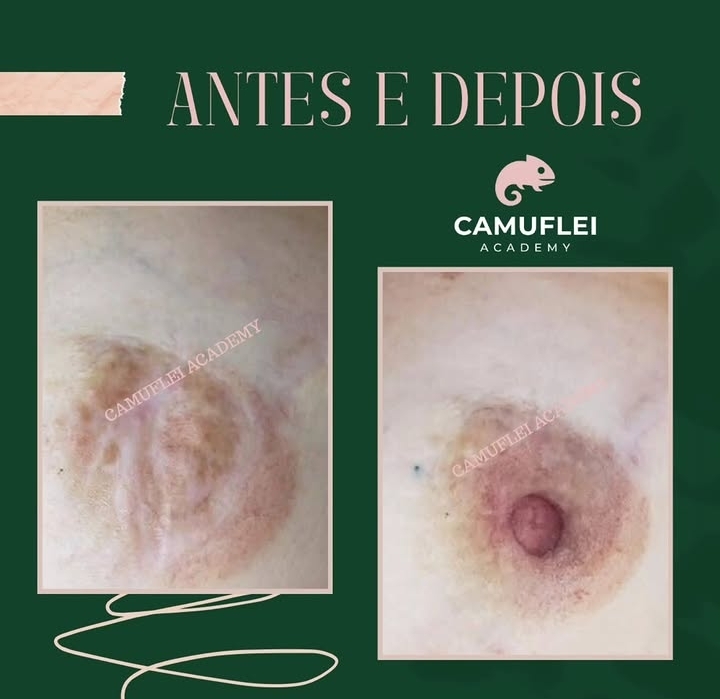 Resultado real de Correção de aréola realista 3D, comparação antes e depois