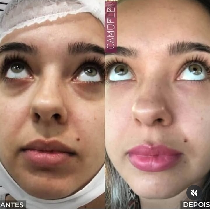 Resultado real de Camuflagem de olheiras, comparação antes e depois